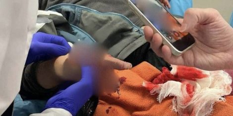 В Солигорске двухлетний ребенок получил травму руки из-за кухонного комбайна
